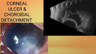 CORNEAL ULCER AND CHOROIDAL DETACHMENT [upl. by Evol]