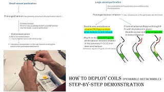 Coronary perforation [upl. by Gerk957]