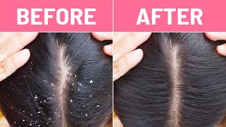 Dirty flaky scalp You need these tips [upl. by Ahtelat]