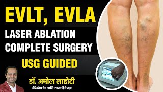 Live Varicose Vein Laser Surgery Full Live Procedure Explained By Dr Amol Lahoti [upl. by Stone]