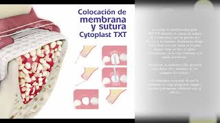 Técnica de preservación alveolar con Membranas y Suturas Cytoplast TXT [upl. by Schreck306]