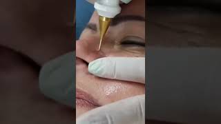 Saiba como eliminar vasinhos na face usando jato de plasma jatodepladna telangiectasias facial [upl. by Yeldarb]