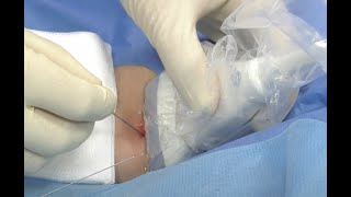 Brachial artery line insertion [upl. by Lodge774]