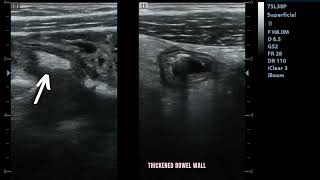 Ultrasound showing Enterocolitis [upl. by Donatelli]