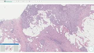 Fibrous Hamartoma of Infancy  Histopathology [upl. by Anniahs]