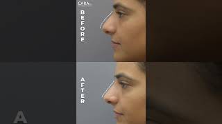 Choosing Cara Clinic for NonSurgical Rhinoplasty [upl. by Hyacinth]