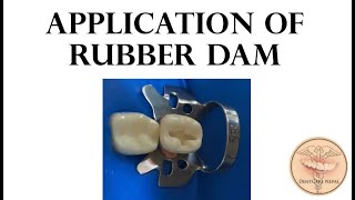 Application of Dental dam  Use of Rubber Dam in Dentistry [upl. by Raskin]