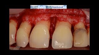 Periodontal Surgery Upper Front Teeth [upl. by Awad693]