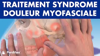 TRAITEMENT du Syndrome de DOULEUR MYOFASCIALE avec physiothérapie © [upl. by Nortad]