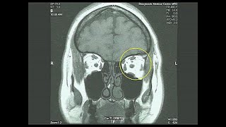 Radiology of the Head with optional subtitles [upl. by Gainor971]