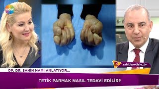 Tetik parmak nasıl tedavi edilir [upl. by Scherman]