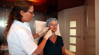 Radiesse behandeling Renew Clinic Zandvoort [upl. by Yllehs]