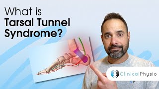 Tarsal Tunnel Syndrome  Expert Physio Guide [upl. by Honna383]