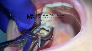 extraction of upper first molar using forceps [upl. by Alverson827]