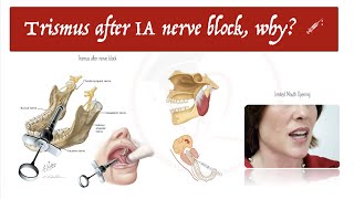 Trismus after Inferior Alveolar Nerve Block 💉 Why 🧐  Part 1 [upl. by Ahsiela]