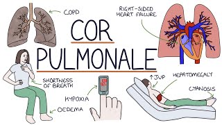 Understanding Cor Pulmonale [upl. by Notsirb615]