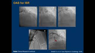 Coronary Atherectomy Tips and Tricks  Sunil Rao MD [upl. by Agiaf]