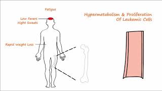 Acute Leukemia  Part 1 [upl. by Eahsal]