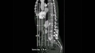 Radiology Rounds  radRounds  Malrotated Right Kidney [upl. by Latsyc]