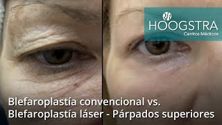 🤔¿Qué blefaroplastia es MEJOR🏆 Blefaroplastía LÁSER🆚 Blefaroplastía CONVENCIONAL  20189 [upl. by Ynamad]