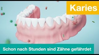 Karies  so schnell sind Zähne in Gefahr [upl. by Ridglee]