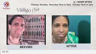 Restoring Pigment Effective Treatment for Vitiligo at Dr Danial’s Clinic [upl. by Rehteh]