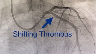 Thrombus Shifts to LCX Acute Anterior MI Cardiogenic Shock Ostial LAD Occlusion How To Treat [upl. by Blaire]