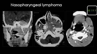 Radiology  Suprahyoid neck  Parapharyngeal spaces [upl. by Adam]