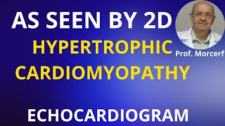 Full Insight into 2D Echo Aspect of Hypertrophic Cardiomyopathy [upl. by Calva]