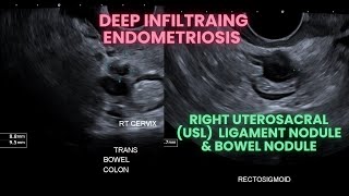 Ultrasound Deep infiltrating endometriosis Bowel nodule and uterosacral ligament nodule [upl. by Alimaj648]