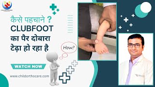 कैसे पहचाने  clubfoot का पैर दुबारा टेडा हो रहा है ll relapse clubfoot relapseclubfoot [upl. by Nodrog]