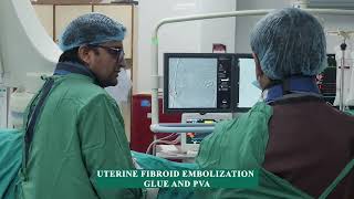 Uterine Fibroid Embolization Glue and PVA  IRFACILITIES [upl. by Vowel865]