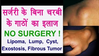 Lipoma Without Surgery चरबी के गाठों का इलाज  Fat Lump Fibrous Tumor Exostosis Cyst Ganglion [upl. by Ecadnak972]