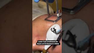 co2 laser treatment for acne scars  DrKasanas Clinic [upl. by Eenej]