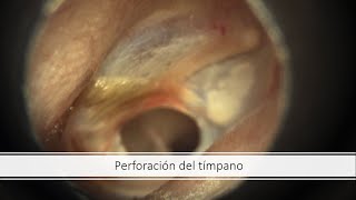 Perforación del tímpano [upl. by Sirrad]