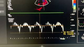 Annulus paradoxus motion in constrictive pericarditis [upl. by Edmon]