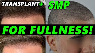 Hair Transplant Enhancement with SMP  3 Ideal Cases To Do It Scalp Micropigmentation [upl. by Eahsal]