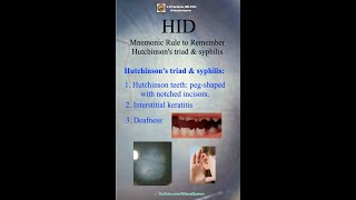 Hutchinsons Triad amp Syphilis HID Mnemonic Rule to Remember Hutchinsons Triad amp Syphilis [upl. by Leon157]