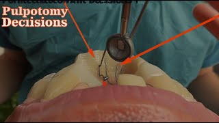 Indications for Coronal vs Partial Pulpotomy Irreversible Pulpitis [upl. by Ormond]