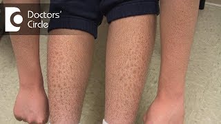 How to manage Ichthyosis Vulgaris in teenage boys  Dr Nischal K [upl. by Anertak]