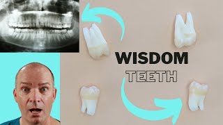 Wisdom teeth on dental xray and in real life [upl. by Ybocaj]