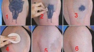 How to Remove a Tattoo without Laser at Home [upl. by Pearla]