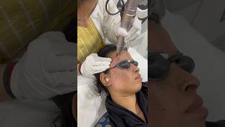 Laser Birthmark removal on face [upl. by Perdita]