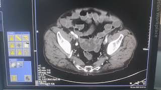 Abdomen Tomografi Radyolijik Anatomi İlaçlı Abdomen Tomogrofi görüntüsü [upl. by Obmar]