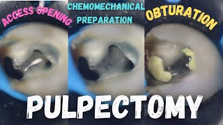 Pulpectomy  access opening  chemomechanical preparation  obturation  pulpectomy procedure 84 [upl. by Lemrej]