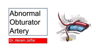 Abnormal aberrant obturator artery corona mortis [upl. by Lashondra]