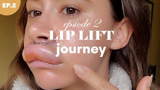 LIP LIFT SURGERY 💉 Episode 2  When it goes very wrong [upl. by Epolulot]