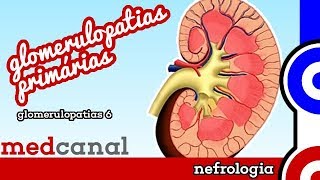 Glomerulopatias Primárias  GLOMERULOPATIAS 6 [upl. by Tripp217]