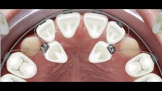 Orthodontic case report for palatally impacted canines traction [upl. by Assetnoc]