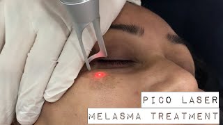 Melasma treatment with PICO Laser [upl. by Amsab]